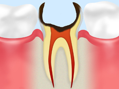 C4　歯の根の虫歯